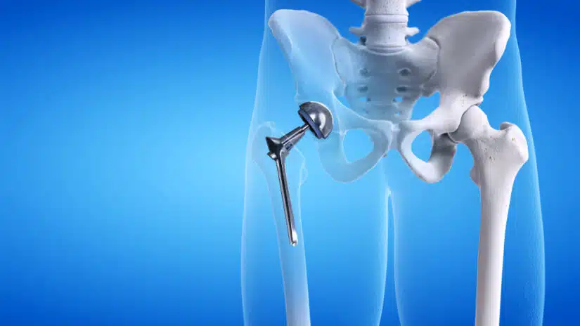 3d,Rendered,Medically,Accurate,Illustration,Of,A,Hip,Replacement